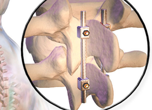 In Situ Spinal Fusion Surgery