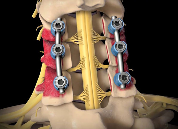 Posterior Spinal Fusion with Instrumentation Surgery