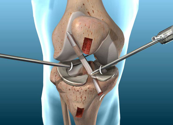 ACL Reconstruction Surgery