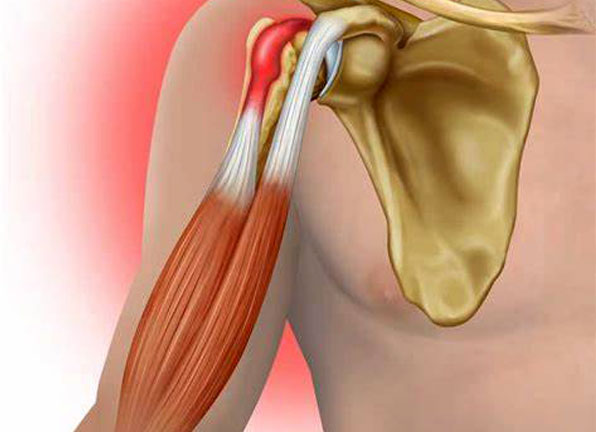 Biceps Tenodesis Surgery