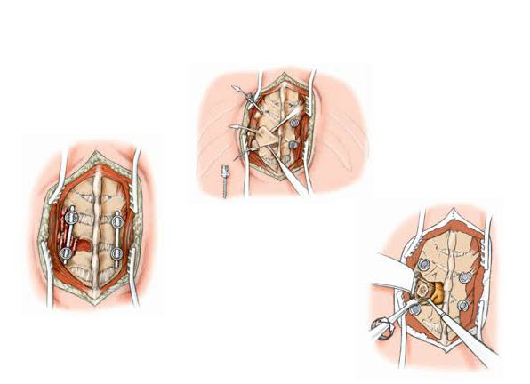 Hemivertebra Resection Surgery