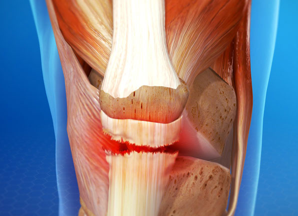 Knee Tendon Repair Surgery