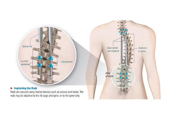 Magnetically Controlled Growing Rod (MCGR) Procedure Surgery