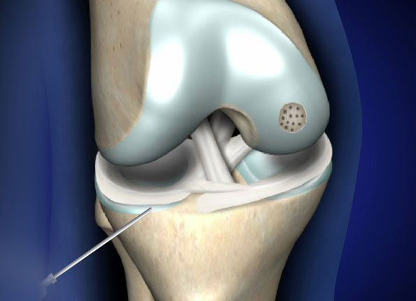 Microfracture Surgery