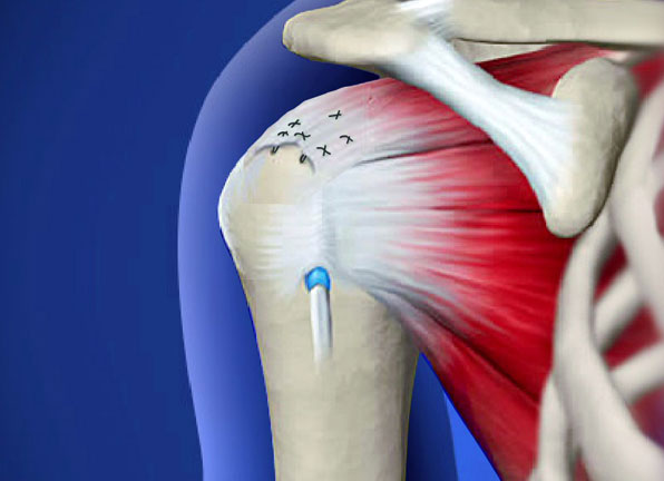 Rotator Cuff Repair Surgery