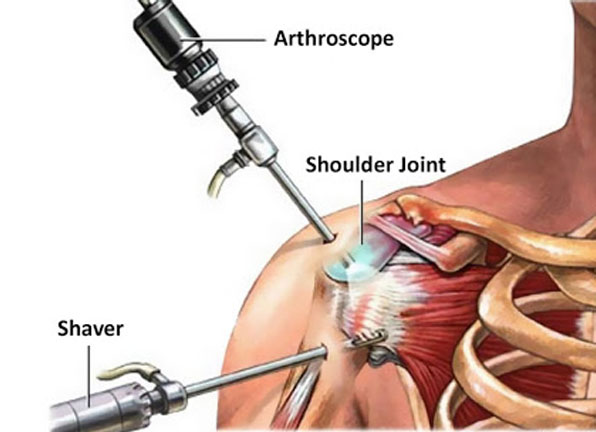 Shoulder Arthroscopy Surgery